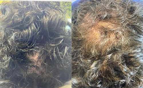 PRP Hair Restoration